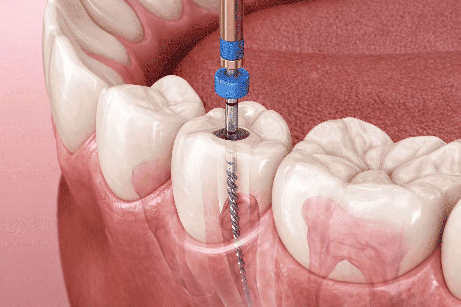 Especialidades Integradas (Endodontia)